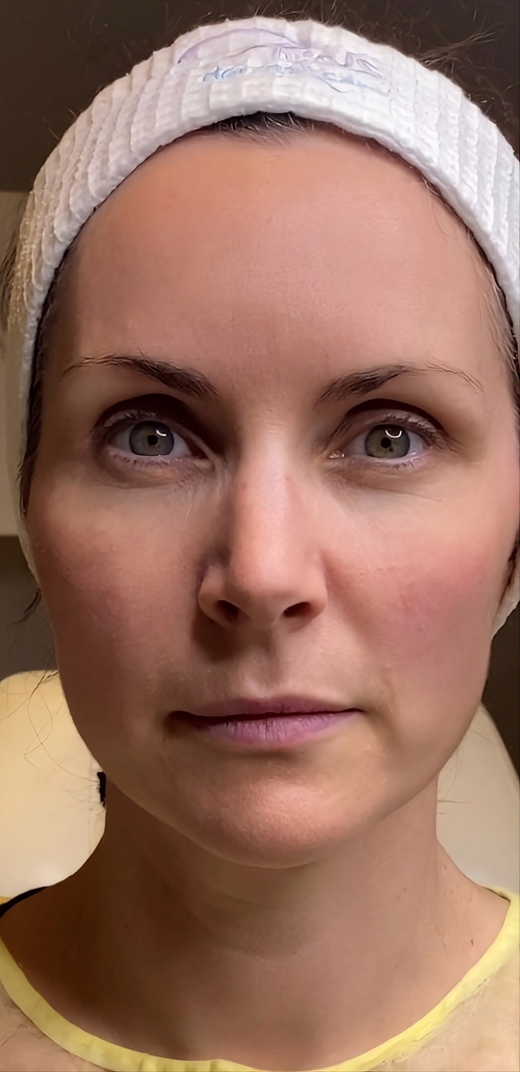 Visage de femme après l'utilisation de l'appareil de lifting EMS et photothérapie LED PureBeam Beauty. Peau raffermie, teint éclatant, regard lissé et effet lifting naturel visible.